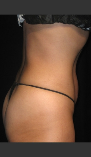 After Photo for QuantaShape #80 -  - Prejuvenation