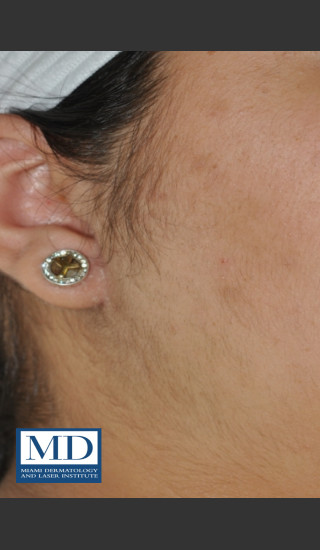 After Photo for Laser Hair Removal 123 - Jill S. Waibel, MD - Prejuvenation