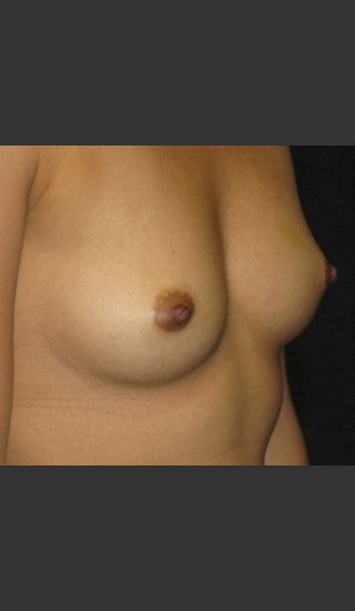 Before Photo for Breast Augmentation - Robert Aycock - Prejuvenation
