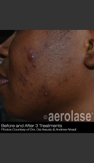 Before Photo for Treatment of Active Acne #304 -  - Prejuvenation