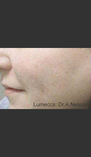 After Photo for Lumecca Intense Pulsed Light #2 -  - Prejuvenation