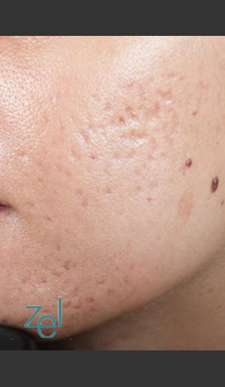Before Photo for Fractional Resurfacing Acne Scars - Brian D. Zelickson, M.D. - Prejuvenation