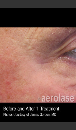 After Photo for Treatment of Crows Feet #339 -  - Prejuvenation