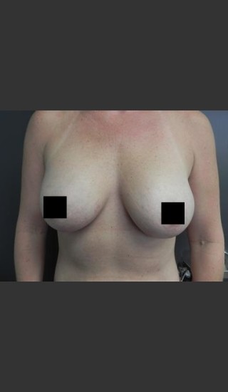 After Photo for Breast Augmentation - Brian P. Tierney, MD - Prejuvenation