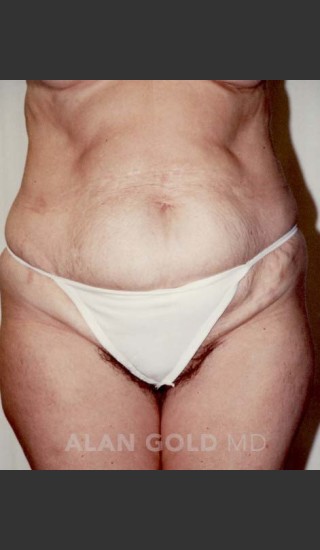 Before Photo for Abdominoplasty 293 - Alan Gold MD - Prejuvenation