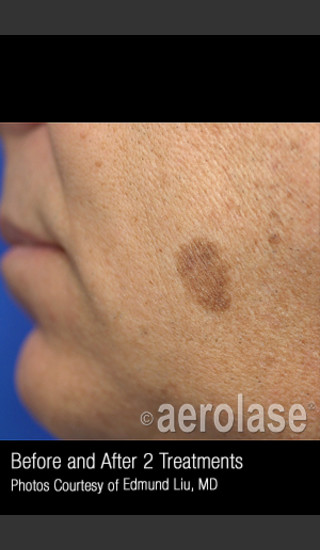 Before Photo for Treatment of Facial Pigmentation #328 -  - Prejuvenation