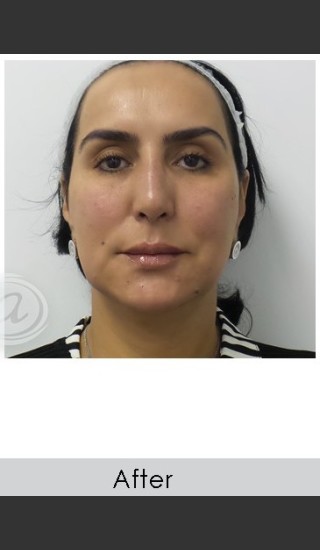 After Photo for Liquid Face Lift - Annie Chiu, MD - Prejuvenation