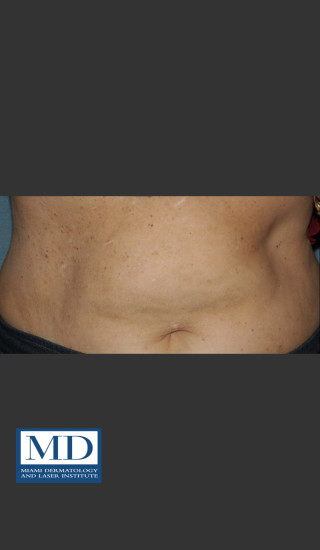 After Photo for Angioma Treatment 106 - Jill S. Waibel, MD - Prejuvenation