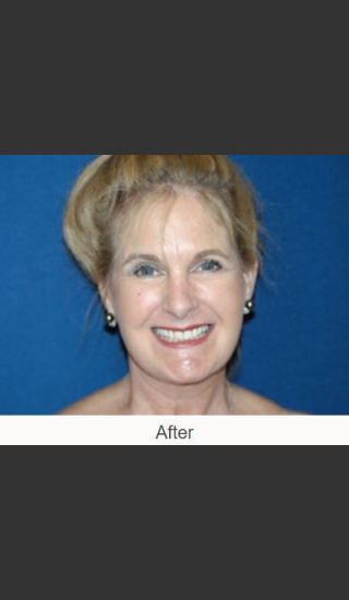 After Photo for Facelift - Case #23 Details - James N. Romanelli, MD, FACS - Prejuvenation
