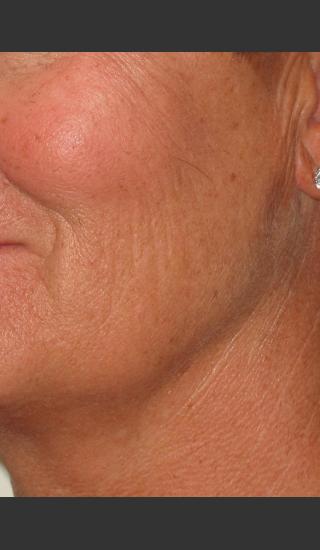 Before Photo for Infini Rhytides Treatment #16 -  - Prejuvenation