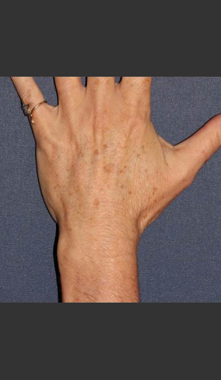 Before Photo for Sun Spot Removal on Hands - Dr. Sabrina G. Fabi - Prejuvenation