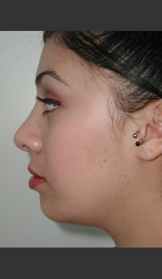 After Photo for Rhinoplasty and Chin Augmentation - James Newman - Prejuvenation
