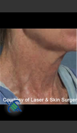 Before Photo for Treatment of Neck Pigmentation - Roy G. Geronemus, M.D. - Prejuvenation