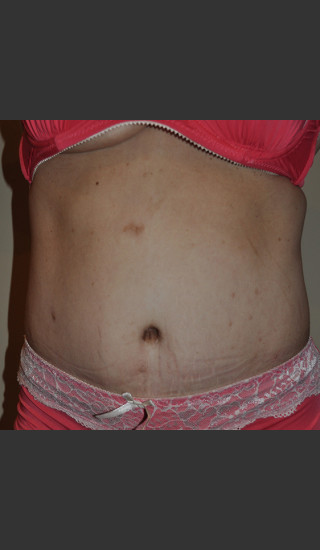 After Photo for Dr. Palmer Tummy Tuck 02 - Shane Palmer - Prejuvenation