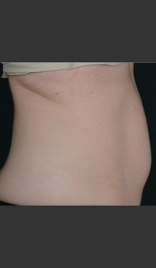 Before Photo for SculpSure Abdomen -  - Prejuvenation