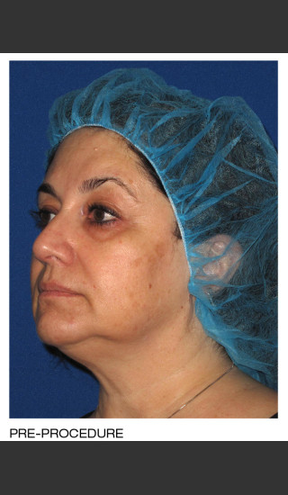 Before Photo for Alastin Skincare Procedure Enhancement System -  - Prejuvenation