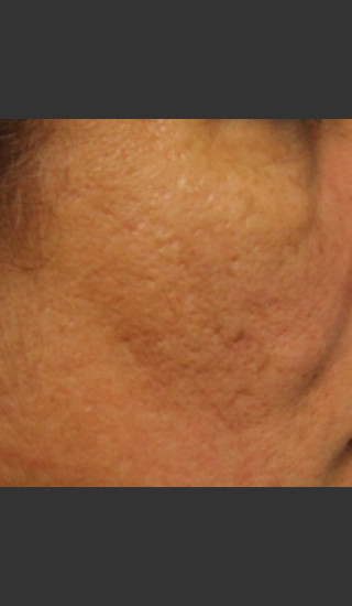 After Photo for Infini Acne Scar Treatment #12 -  - Prejuvenation