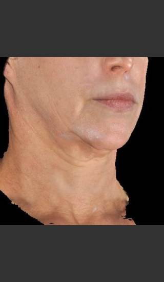 Before Photo for Infini Rhytides and Facial Laxity #14 -  - Prejuvenation