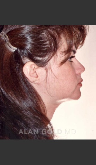 After Photo for Liposuction of Neck 96 Side View - Alan Gold MD - Prejuvenation