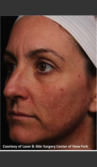 Before Photo for Facial Skin Rejuvenation with Clear and Brillant Permea - Roy G. Geronemus, M.D. - Prejuvenation