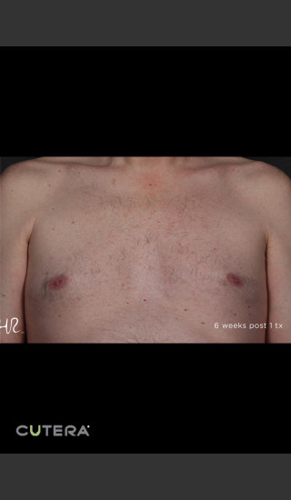 After Photo for Hair Removal of Chest With Excel HR -  - Prejuvenation