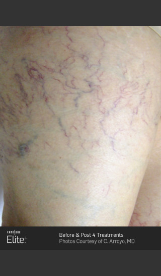 Before Photo for Leg Vein Clearance Using Elite -  - Prejuvenation