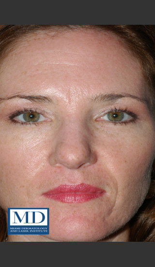 After Photo for Photorejuvenation Treatment 110 - Jill S. Waibel, MD - Prejuvenation