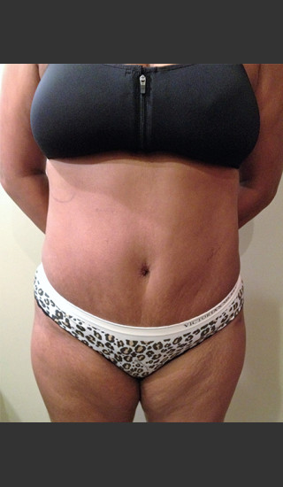 After Photo for Dr. Palmer Tummy Tuck 01  - Shane Palmer - Prejuvenation