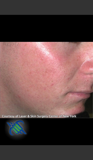 After Photo for Treatment of Facial  Acne Scars - Roy G. Geronemus, M.D. - Prejuvenation