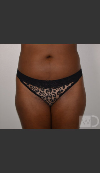 Before Photo for SmartLipo Liposuction of Outer Thighs - Chuma Chike-Obi MD - Prejuvenation