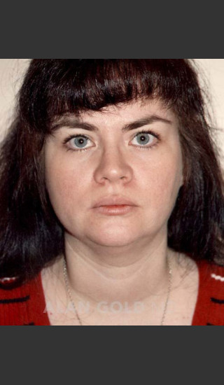 Before Photo for Liposuction of Neck 96 - Alan Gold MD - Prejuvenation