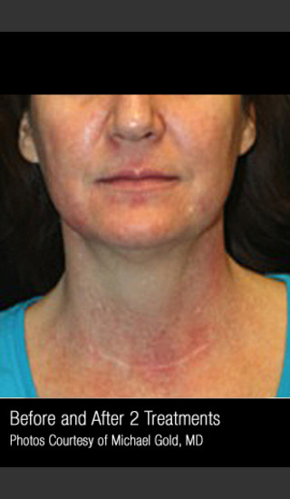 Before Photo for Treatment of Pigmentation & Redness #332 -  - Prejuvenation