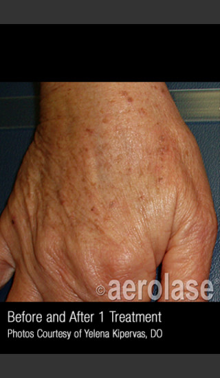 Before Photo for Treatment of Pigmentation #329 -  - Prejuvenation