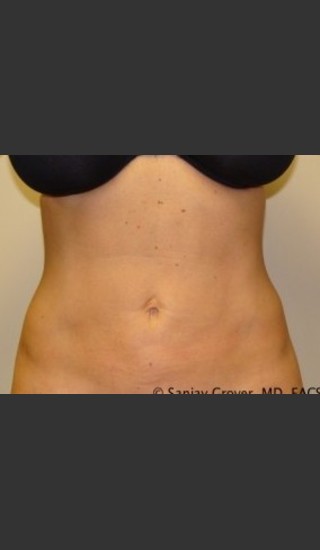 After Photo for Liposuction of Abdomen 8087 - Sanjay Grover MD FACS - Prejuvenation