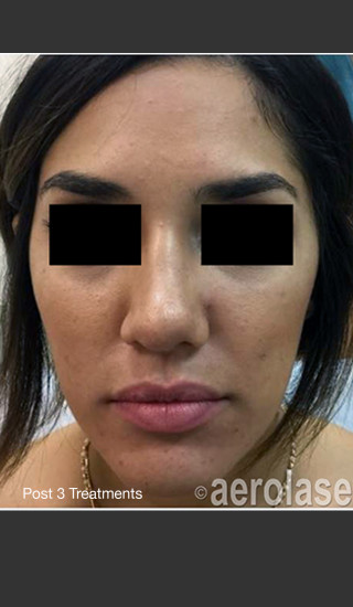 After Photo for NeoClear by Aerolase Acne Treatment -  - Prejuvenation