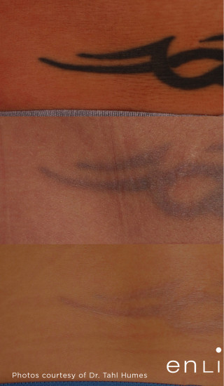 Before Photo for Tattoo Removal on Lower Back -  - Prejuvenation