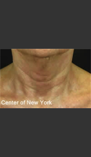 After Photo for Treatment of Fine lines and Wrinkles -  - Prejuvenation