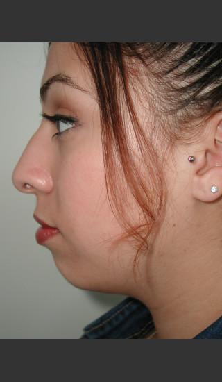 Before Photo for Rhinoplasty and Chin Augmentation - James Newman - Prejuvenation