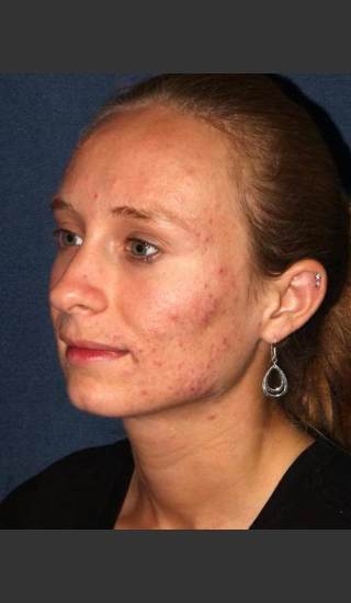 Before Photo for Facial Acne Treatment - Dr. Sabrina G. Fabi - Prejuvenation