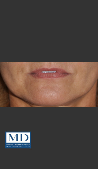 Before Photo for Lip Filler 133 - Jill S. Waibel, MD - Prejuvenation