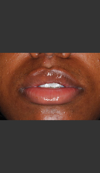 After Photo for Treatment of Lips - Roy G. Geronemus, M.D. - Prejuvenation