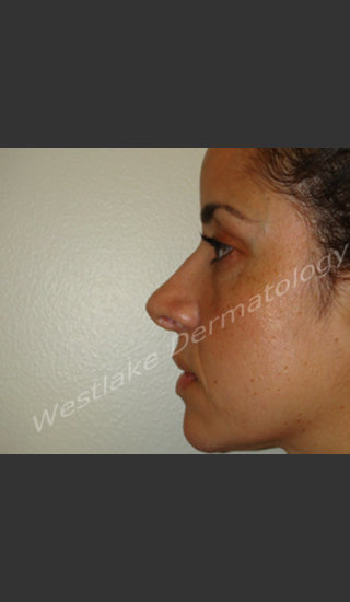 After Photo for Rhinoplasty Treatment of Female Patient - Cameron Craven MD FACS - Prejuvenation