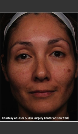 Before Photo for Treatment of Melasma -  - Prejuvenation