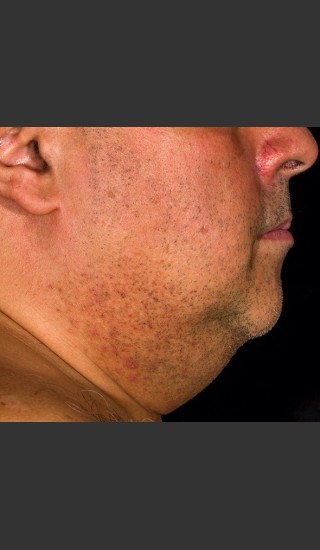 Before Photo for SculpSure Submental - Lawrence Bass MD - Prejuvenation