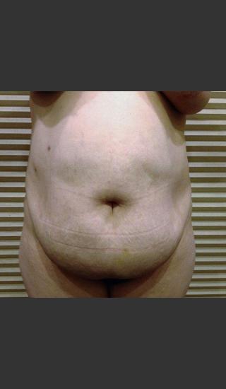 Before Photo for Dr. Palmer Tummy Tuck 02 - Shane Palmer - Prejuvenation