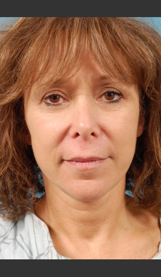 After Photo for Facelift Surgery - Thomas A. Mustoe, MD, FACS - Prejuvenation