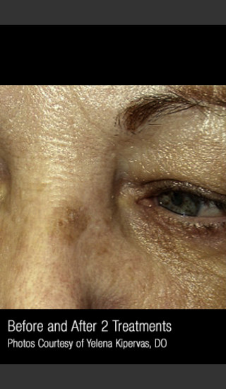 Before Photo for Treatment of Facial Pigmentation #330 -  - Prejuvenation