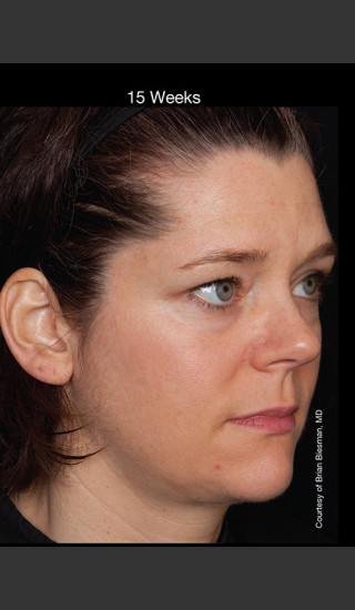 After Photo for Hyperpigmentation - Professional Peel - Brian S. Biesman, MD - Prejuvenation