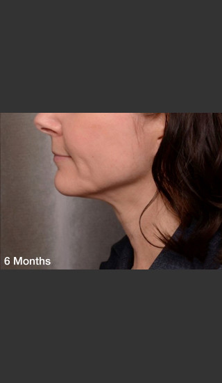 After Photo for ThermiTight Treatment -  - Prejuvenation