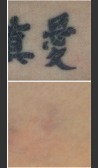 After Photo for Laser Treatment of Tattoo -  - Prejuvenation